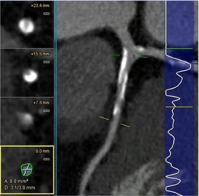 Computed tomographic angiography measures of coronary plaque in clinical trials: opportunities and considerations to accelerate drug translation